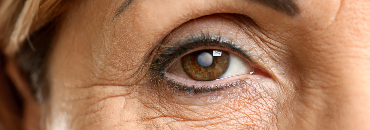 woman with cataract